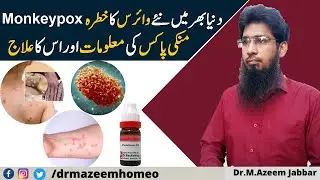What is Monkeypox Virus ? || Homeopathic Treatment , Symptoms, Causes , Prevention Urdu || Hindi
