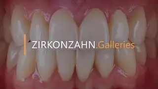 Minimally invasive restoration with ultra-thin zirconia veneers | Zirkonzahn.Galleries