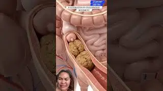 Constipation movement #anatomy #humanbody #everyone #keepdiscovering #studywithme