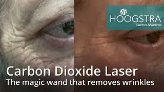 Carbon Dioxide Laser - The magic wand that removes wrinkles (20162)