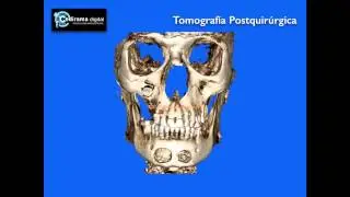Fistula Oroantral