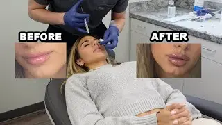 GETTING LIP FILLER AND BOTOX FOR THE FIRST TIME!