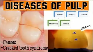 DISEASES OF THE PULP II CAUSES II CRACKED TOOTH SYNDROME II PULPAL DISEASE SERIES (part-1) II imp