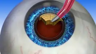 Laser Cataract Surgery at Visual Health in Palm Springs, Florida