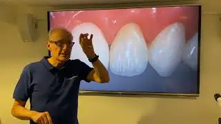 RESTAURATIONS ESTHETIQUES DU SOURIRE SANS PREPARATION OU MICRO-INVASIVE 4