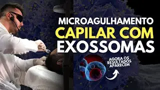 Microagulhamento CAPILAR com EXOSSOMAS | Aula prática