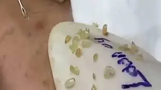 relax everyday with dep sac spa | blackheads extractions