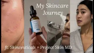 My Skin Journey (Dealing With Hormonal Acne, Congestion, and Texture ft. Skinceuticals)