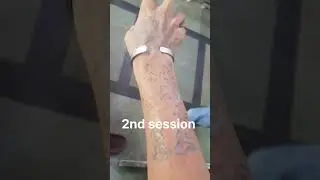Tattoo removal 4th session at R tattoo studio located in ghatkopar mumbai