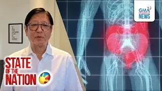 Diverticulitis na iniinda ni PBBM, namamana o dahil sa mga kinakain, ayon sa eksperto | SONA