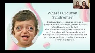 Crouzon Syndrome