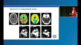 Benefits of Spectral CT in Neurocardiology