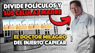 EL DOCTOR de los MILAGROS en Injerto Capilar DIVIDE FOLÍCULOS y sus Células Madre con la Técnica HST