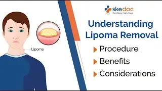 Understanding Lipoma Removal: Procedure, Benefits, and Considerations