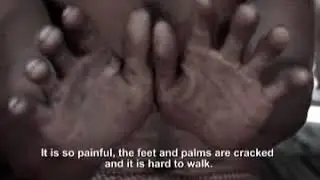 Arsenic  An Invisible Poison