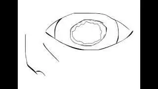 Ectopia Lentis