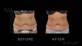 EMSCULPT Reviews | EMSCULPT Beverly Hills, Lasky Aesthetics & Laser Center, Los Angeles