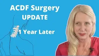 ACDF Surgery 1 Year Update -Does it take a year? (Update 3)