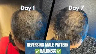 Week 1 Of Reversing My Male Pattern Baldness✅️ Baldness Treatment🔥