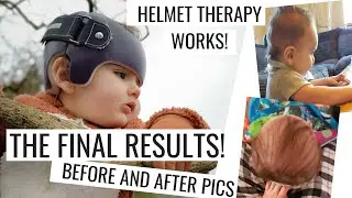 Flat Head Syndrome| Helmet Therapy|Final Results|Plagiocephaly|Brachycephaly
