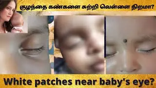 White patches near baby's eye in tamil| white patches on baby face in tamil |  Reasons & remedies
