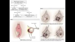 Бартолиновые железы, киста бартолиновой железы, абсцесс бартолиновой железы, рак бартолиновой железы