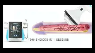 Focus shockwave for ED treatment 