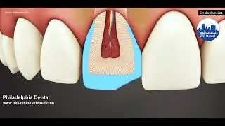 Dental Bonding for Tooth Enamel Fracture - Philadelphia Dental