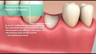 🦷 Day 5 After a Tooth Extraction &mdash; Is This Normal?