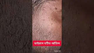 Viral wart #dermatologist #shorts #drgsmukherjee #verruca #wart