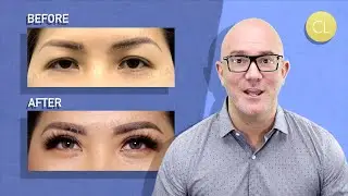 #ChasingGoals Asian Eyelid Surgery Experience: with Dr. Lay - Episode 10