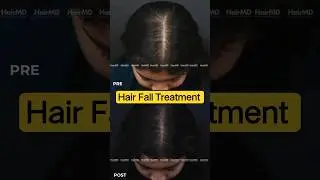 Hair Fall at a Young Age? Watch This Dermatologist Approved Recovery Story! | HairMD Clinic, Pune