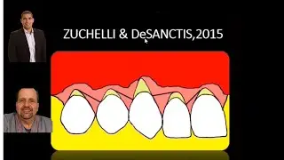T&eacute;cnica de zuchelli (recobrimento radicular) @dr.alexguedes