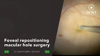 Orbit tips 061   Foveal repositioning macular hole surgery