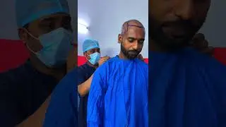 India's best hair transplant clinic in Delhi - Belleza Rohini #hairtransplant