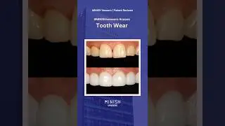 Tooth Wear at 30? Here&rsquo;s How to Treat It Without Crowns