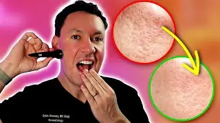 Improve Acne Scars At Home THIS Works | Dermatologist Explains