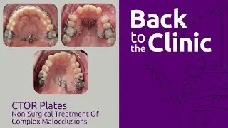 CTOR Plates: Non-surgical Treatment of Complex Malocclusions - Back to the Clinic #003