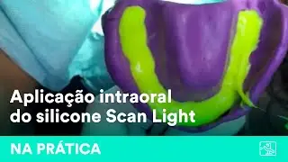Moldagem com aplica&ccedil;&atilde;o intraoral do silicone de adi&ccedil;&atilde;o Scan Light | por dr. C&aacute;ssio Pontes