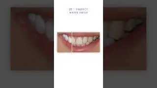 Don&rsquo;t Let Anything Hold You Back from Smiling | Smile Transformation | Perfect White Smile