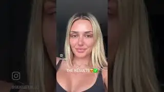 NEWEST FACIAL in Newport Beach- Skinsation OC