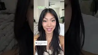 Face Slimming with masseter botox