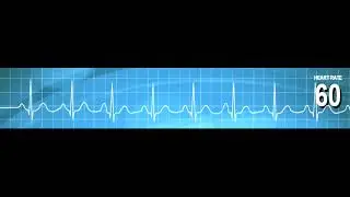 Second Degree AV Block Type II