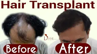 Best Hair Transplant Result @ Divine Cosmetic Surgery