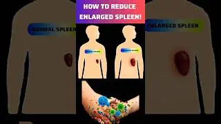 How To Treat Enlarged Spleen | How To Reduced Enlarged Spleen #spleen