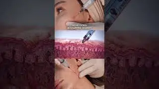 Sculptra collagen stimulator #collagen #sculptra #skincare #beauty #process #skincareroutine