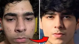 Remove Acne Scars Naturally | 3 Remedies (100% Works) With Results