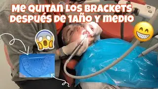 Me quitan los brackets por fin después de 1año y medio con ellos 