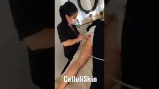 Traiter la cellulite avec le CelluliSkin