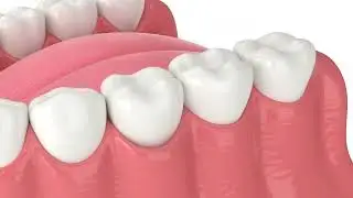 Couronne sur implant apr&egrave;s une extraction de dent - EmpireDent, clinique dentaire de Hongrie